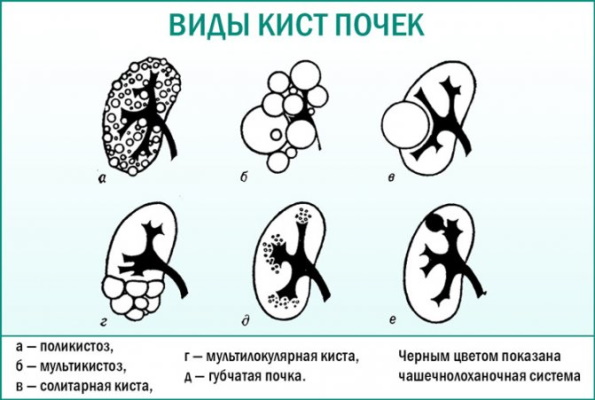 Симптоматическая артериальная гипертензия (вторичная). Что это такое