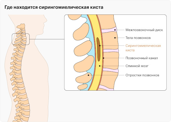 Сирингомиелия шейного и грудного отделов позвоночника. Симптомы и лечение у женщин