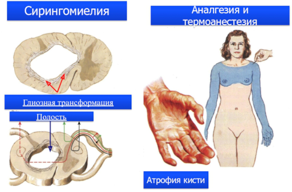 Сирингомиелия шейного и грудного отделов позвоночника. Симптомы и лечение у женщин