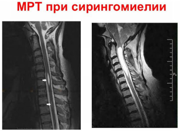 Сирингомиелия шейного и грудного отделов позвоночника. Симптомы и лечение у женщин