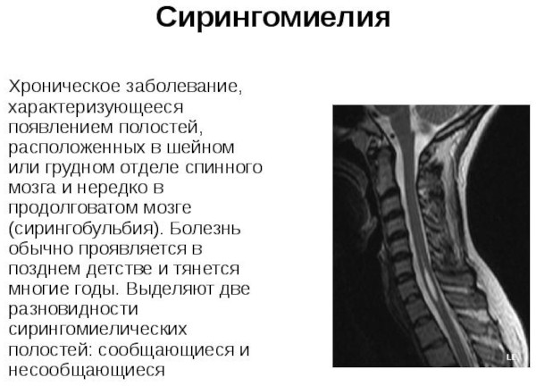 Сирингомиелия шейного и грудного отделов позвоночника. Симптомы и лечение у женщин