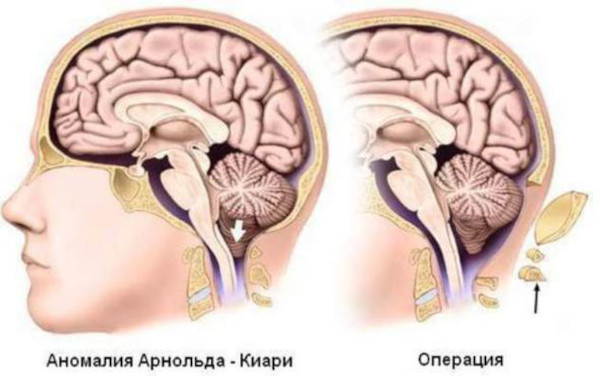 Сирингомиелия шейного и грудного отделов позвоночника. Симптомы и лечение у женщин