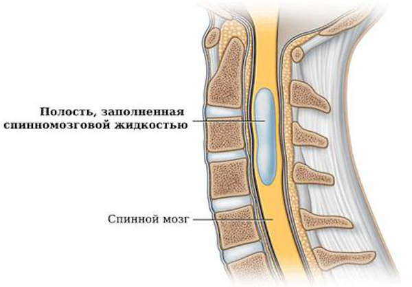 Сирингомиелия шейного и грудного отделов позвоночника. Симптомы и лечение у женщин
