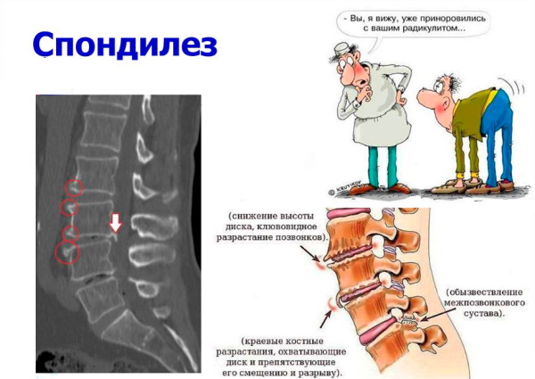 Спондилез грудного отдела позвоночника. Что это такое, симптомы, лечение