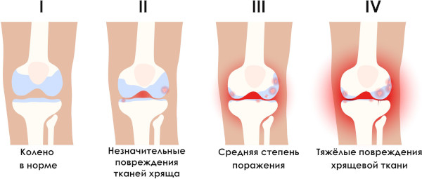 Таблетки от артроза коленного сустава, лекарства недорогие, эффективные