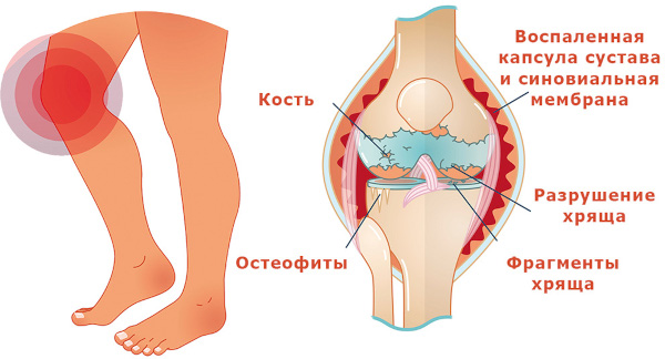 Таблетки от артроза коленного сустава, лекарства недорогие, эффективные