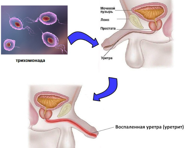 Урологические заболевания у мужчин. Симптомы и лечение болезней