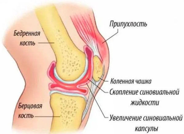 Ушиб коленного сустава. Лечение, мази