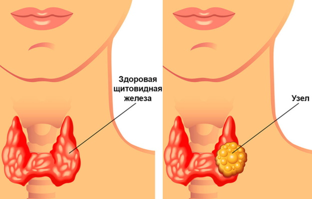 Узлы в щитовидной железе. Опасность, размер, норма, лечение