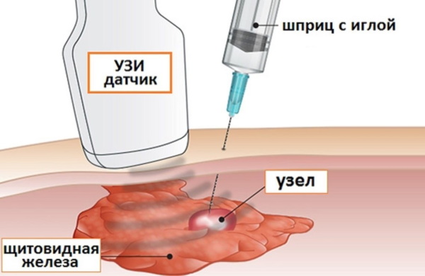 Узлы в щитовидной железе. Опасность, размер, норма, лечение