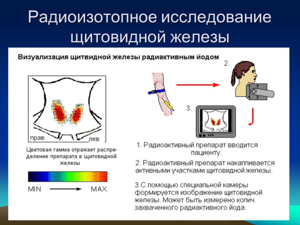 Болезнь Грейвса. Что это, симптомы, лечение