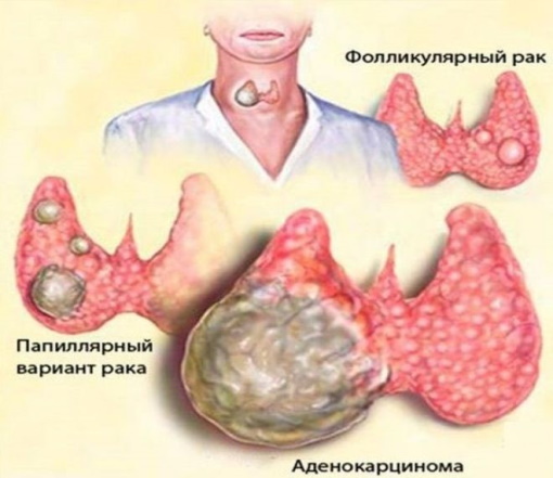 Узлы в щитовидной железе. Опасность, размер, норма, лечение