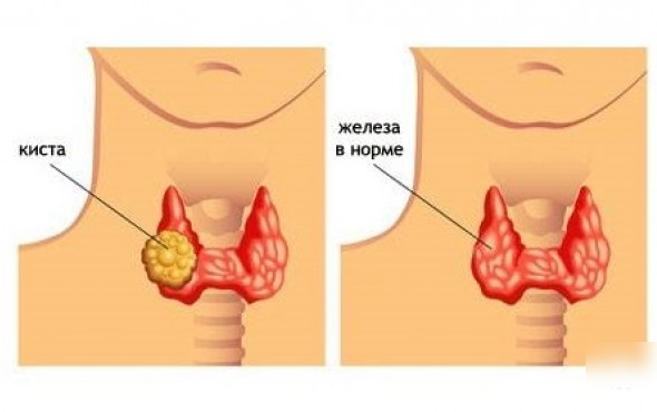 Узлы в щитовидной железе. Опасность, размер, норма, лечение