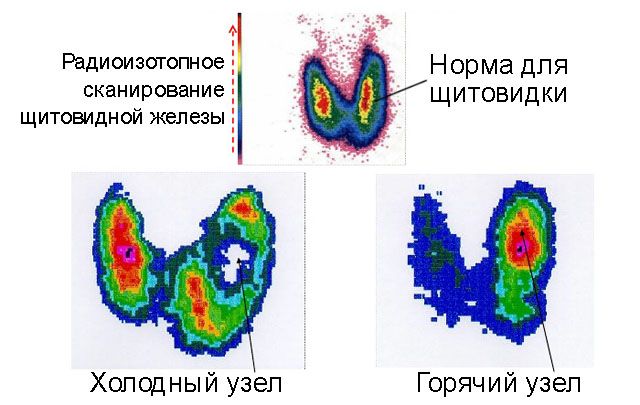 Узлы в щитовидной железе. Опасность, размер, норма, лечение