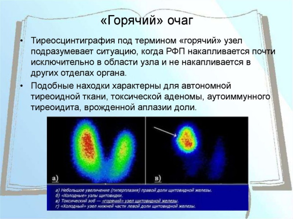 Узлы в щитовидной железе. Опасность, размер, норма, лечение