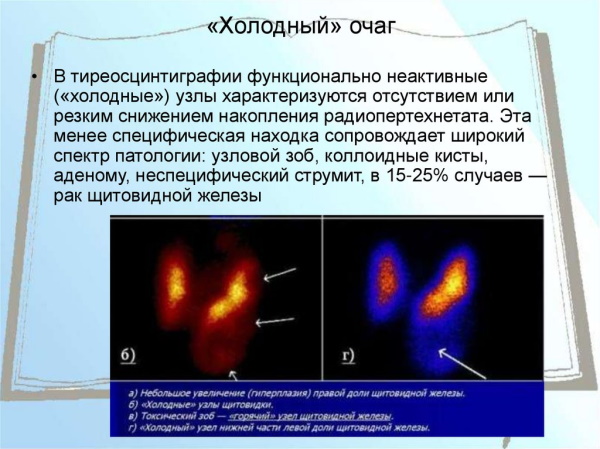 Узлы в щитовидной железе. Опасность, размер, норма, лечение