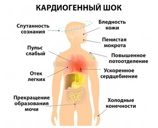 Аритмия сердца. Симптомы, лечение, первая помощь