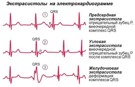 Аритмия сердца. Симптомы, лечение, первая помощь