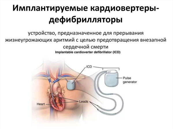 Аритмия сердца. Симптомы, лечение, первая помощь