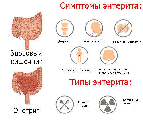 Болезни кишечника у мужчин. Симптомы, признаки