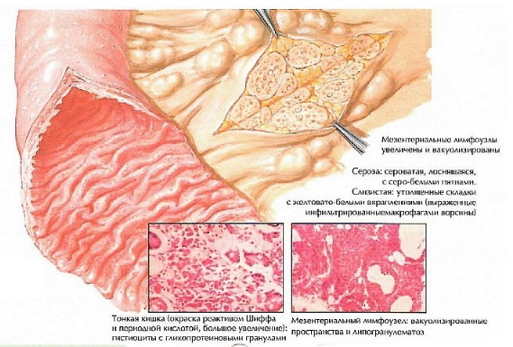 Болезни кишечника у мужчин. Симптомы, признаки