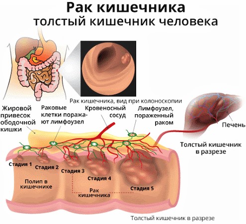 Болезни кишечника у мужчин. Симптомы, признаки