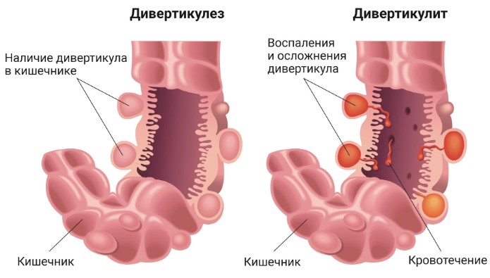 Болезни кишечника у мужчин. Симптомы, признаки