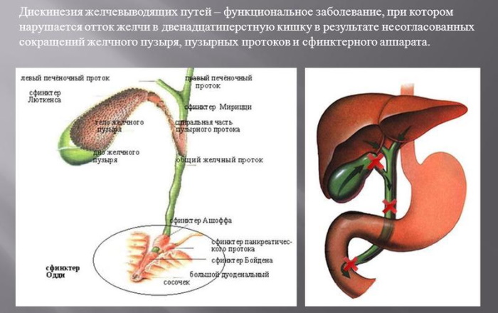 Дискинезия желчевыводящих путей по гипокинетическому типу. Что это, лечение