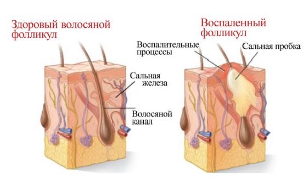 Гидраденит. Что это, фото воспаления, лечение