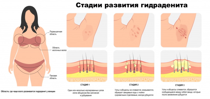 Гидраденит. Что это, фото воспаления, лечение