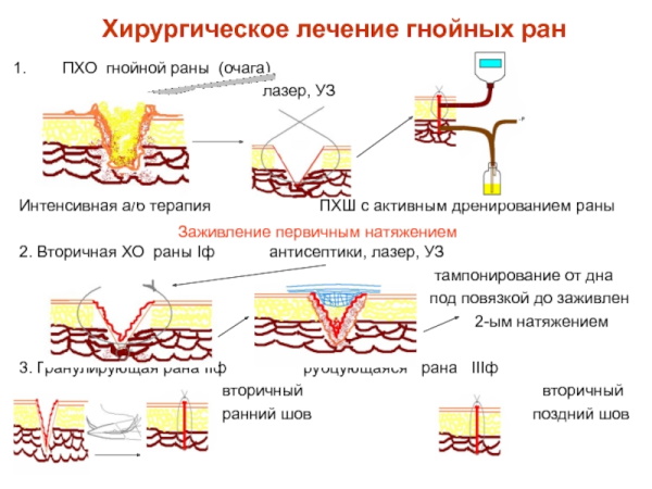 Гидраденит. Что это, фото воспаления, лечение