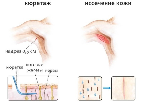 Гидраденит. Что это, фото воспаления, лечение