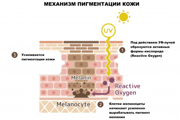 Хлоазма на лице. Фото, что это, как избавиться