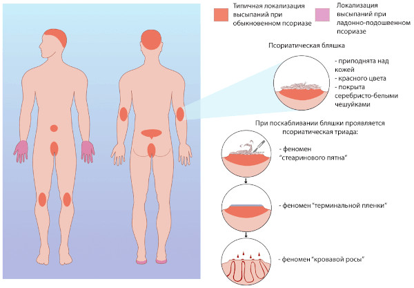 Кебнера феномен. Фото, что это при псориазе, витилиго, красном плоском лишае