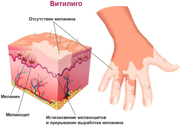 Кебнера феномен. Фото, что это при псориазе, витилиго, красном плоском лишае