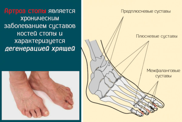 Лечение артроза стопы ног в домашних условиях