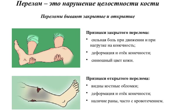 Открытый перелом ноги. Что делать, первая помощь