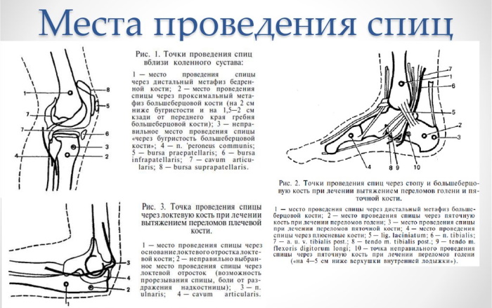 Открытый перелом ноги. Что делать, первая помощь