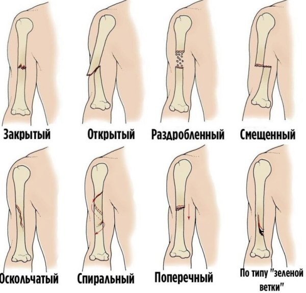 Открытый перелом руки. Первая помощь, сколько заживает