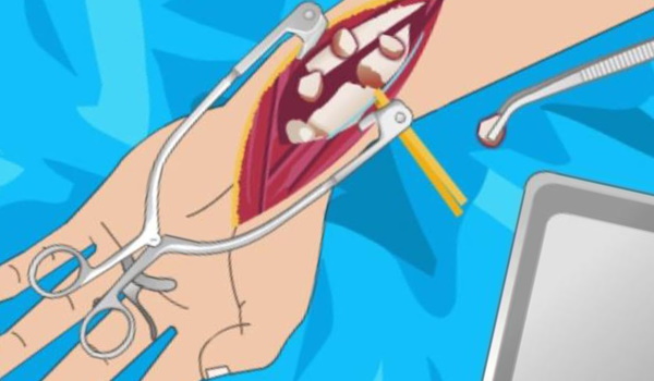 Открытый перелом руки. Первая помощь, сколько заживает