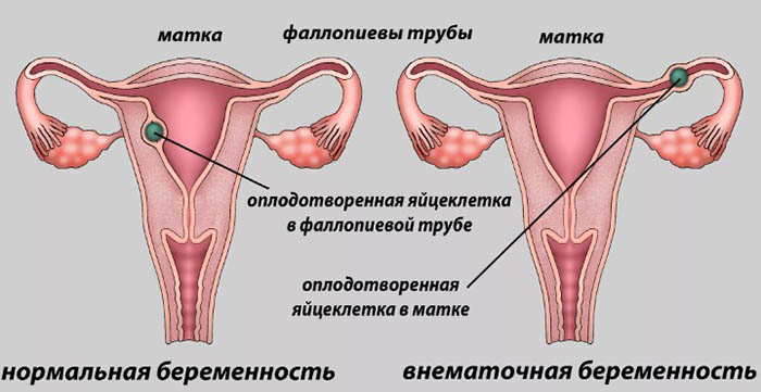 Тянет низ живота после месячных. Причины у женщин