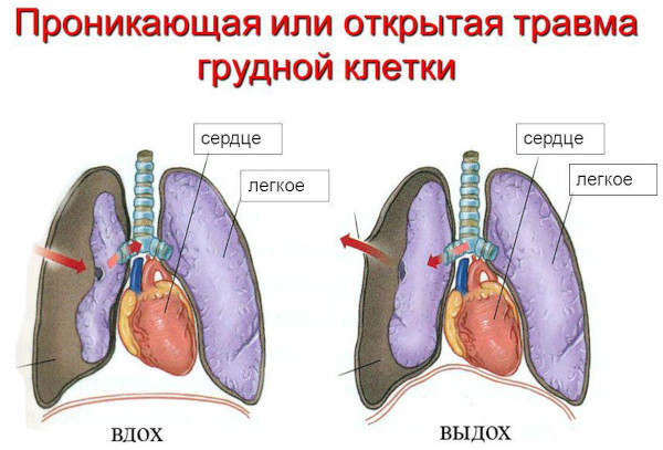 Ушиб грудной клетки. Лечение после удара