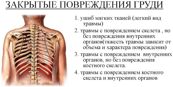 Ушиб грудной клетки. Лечение после удара