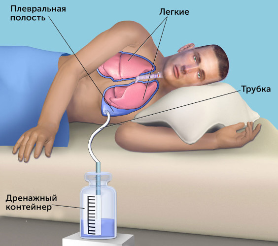 Ушиб грудной клетки. Лечение после удара