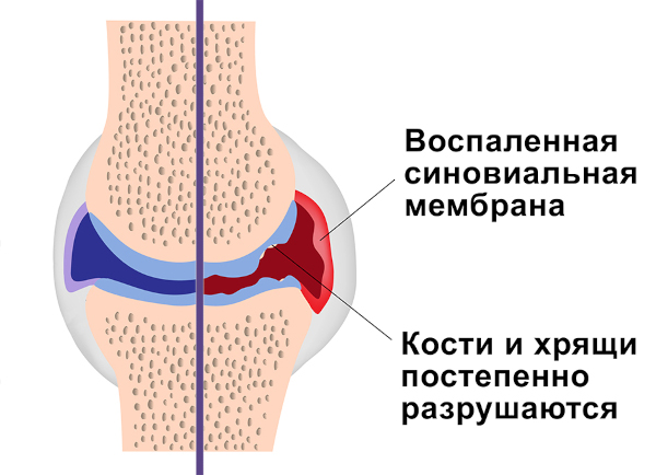 УЗИ тазобедренных суставов у взрослых. Что показывает, как делается