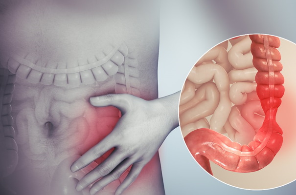 Заболевания кишечника. Симптомы и признаки у женщин