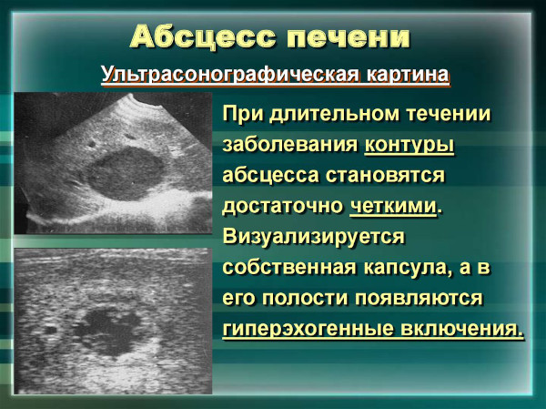 Абсцесс печени. Причины, что это, клинические рекомендации