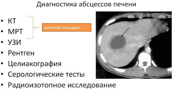 Абсцесс печени. Причины, что это, клинические рекомендации