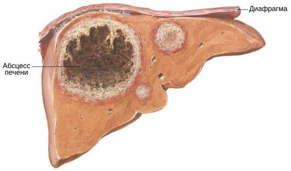 Абсцесс печени. Причины, что это, клинические рекомендации