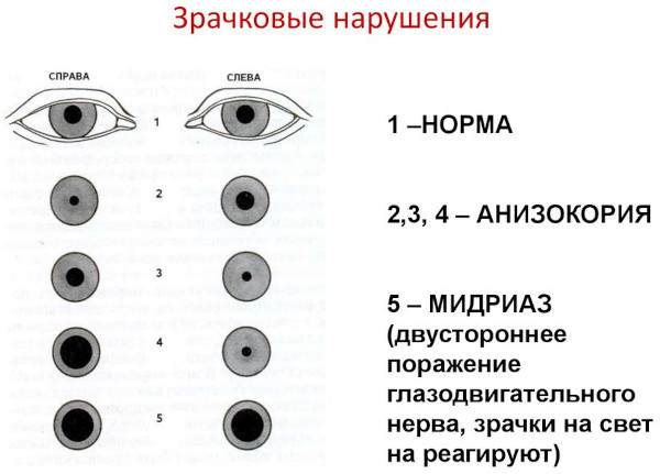 Анизокория это что в медицине. Причины, симптомы